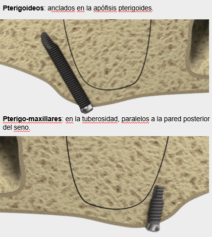 implantes pterigoideos IDIM clinica de implantes dentales en valencia