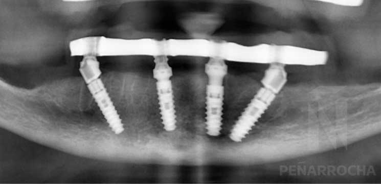 implantes angulados inferiores idim clinica de implantes dentales en valencia