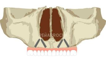implantes angulados tecnica combinada con implantes all on four en valencia idim clinica de implantes dentales en valencia