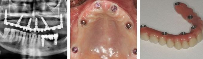 implantes angulados valencia