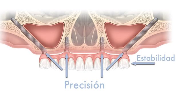implantes cigomaticos
