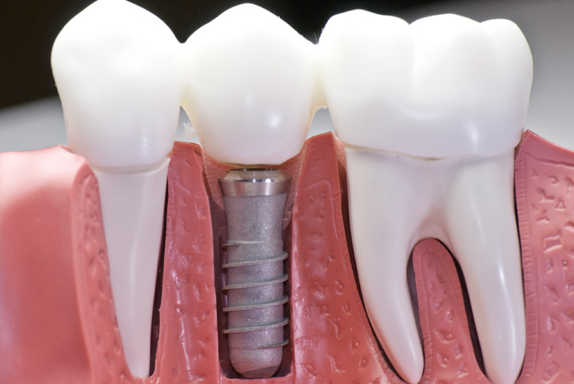 Implantes dentales inmediatos postextraccion