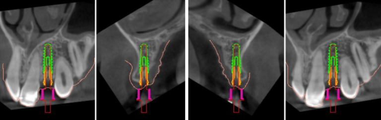 implantes dentales sin cirugia en valencia IDIM clinica de implantes dentales en valencia