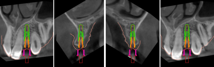 implantes dentales sin cirugia en valencia IDIM clinica de implantes dentales en valencia
