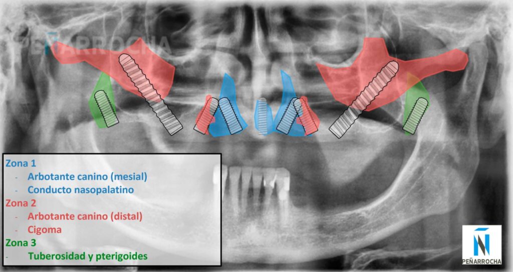 implantes dentales sin hueso en maxilar atrofico superior idim clinica de implantes dentales en valencia