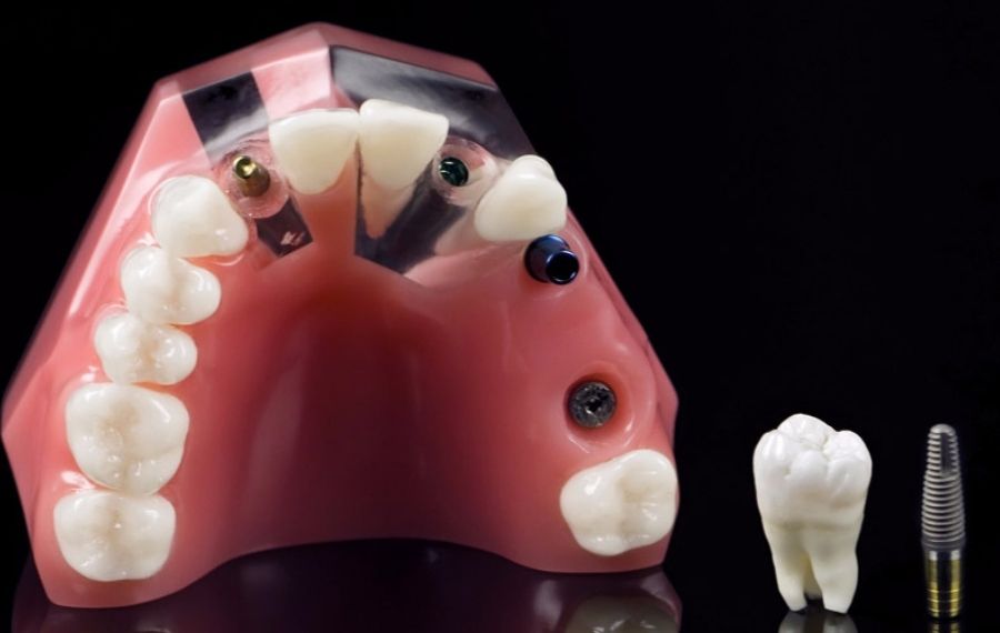 implantes dentales tras elevacion de seno maxilar