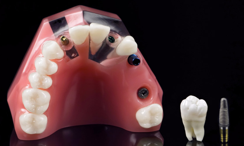 Implantes dentales después de elevación de seno maxilar