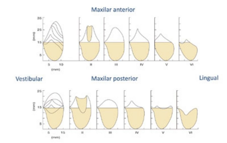 implantes en atrofias oseas