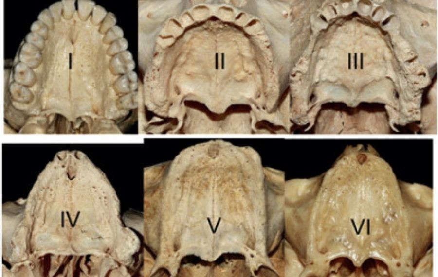 implantes palatinizados
