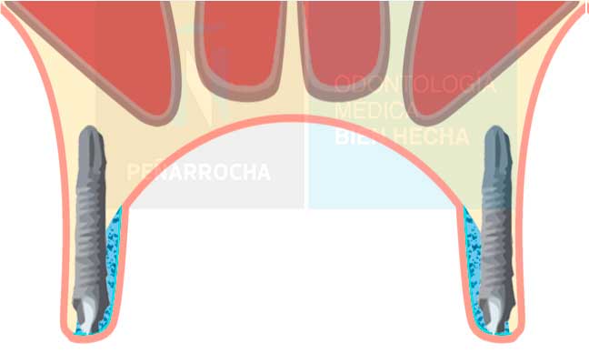 implantes palatinizados idim clinica de implantes dentales en valencia