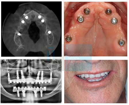implantes palatinizados solucion atrofias oseas idim clinica de implantes dentales en valencia