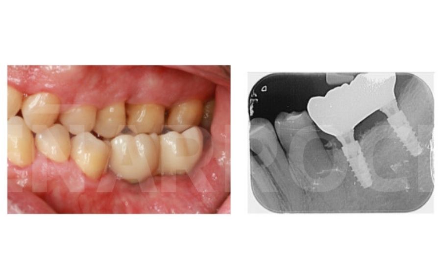injerto de hueso valencia para implantes dentales
