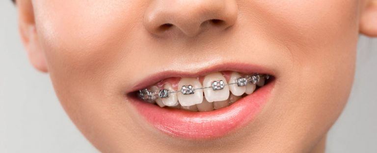 limar dientes o stripping dental