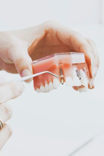 maqueta implantes dentales valencia