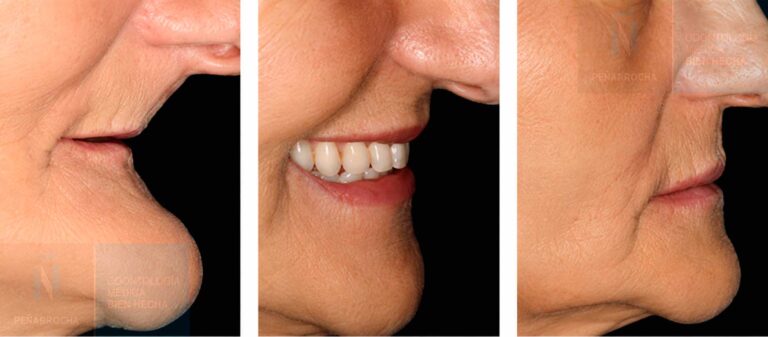 maxilar atrofico soluciones con implantes dentales sin hueso idim clinica de implantes dentales en valencia