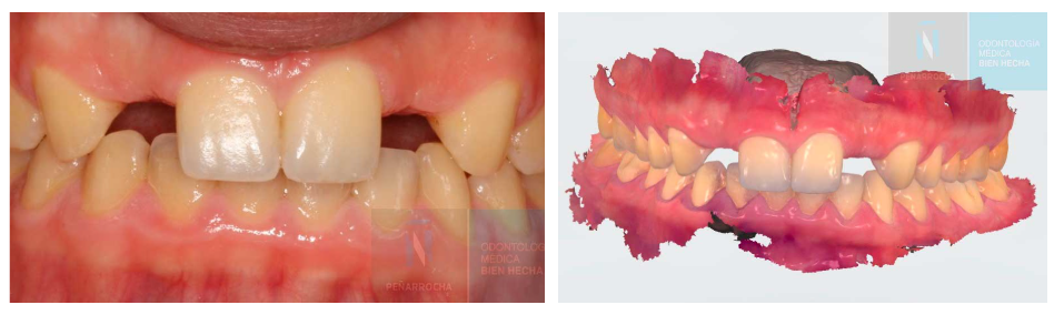 Como se hacen los implantes dentales sin cirugía paso a paso IDIM clinica de implantes dentales en valencia