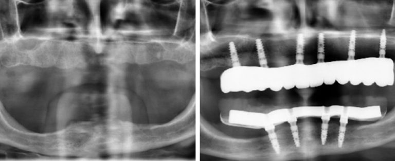 poco hueso maxilar por que se produce la atrofia maxilar IDIM clinica implantes dentales valencia