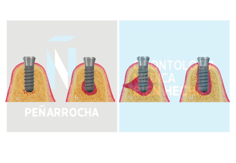 portada fracaso de implantes dentales causas tratamientos idim clinica de implantes dentales en valencia