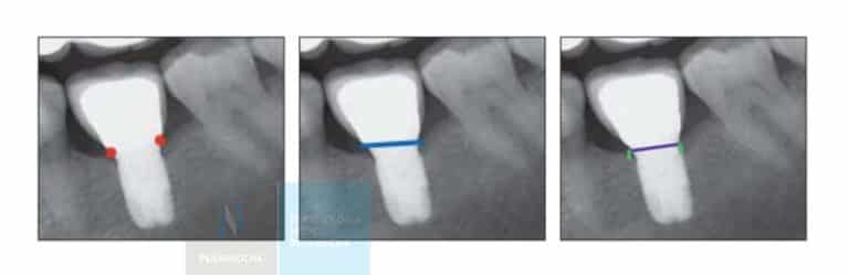 portada implantes inmediatos idim clinica de implantes dentales en valencia