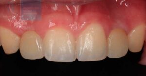 protesis definitiva implantes dentales sin cirugia en valencia IDIM clinica de implantes dentales en valencia