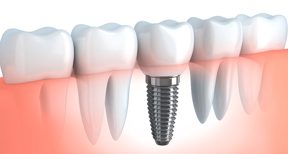 Protesis fijas sobre implantes dentales