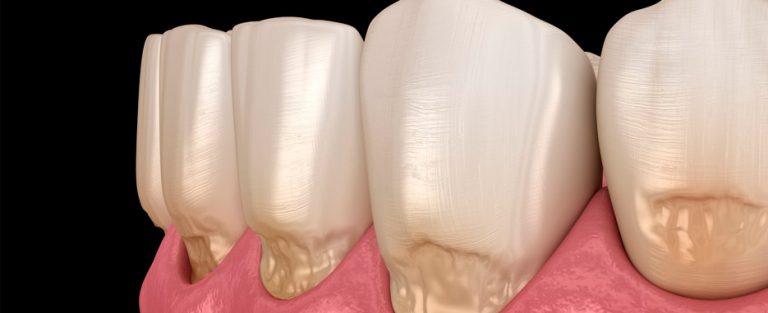 que es la abfraccion dental