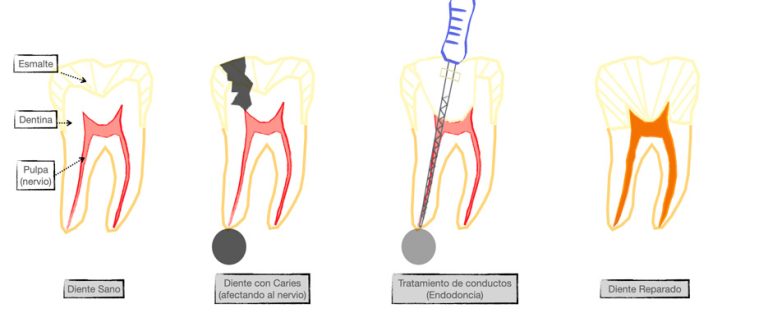 que es la endodoncia