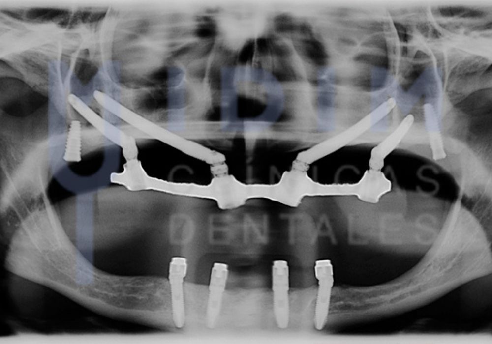 que son implantes cigomaticos