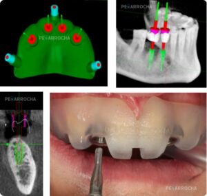 que son los implantes dentales sin cirugia en valencia IDIM clinica de implantes dentales en valencia