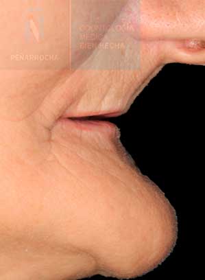 quien se puede hacer implantes dentales con poco hueso en valencia idim clinica de implantes dentales en valencia