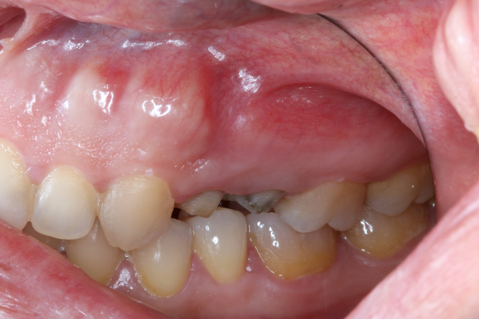 restauracion de dientes cortos o muy destruidos