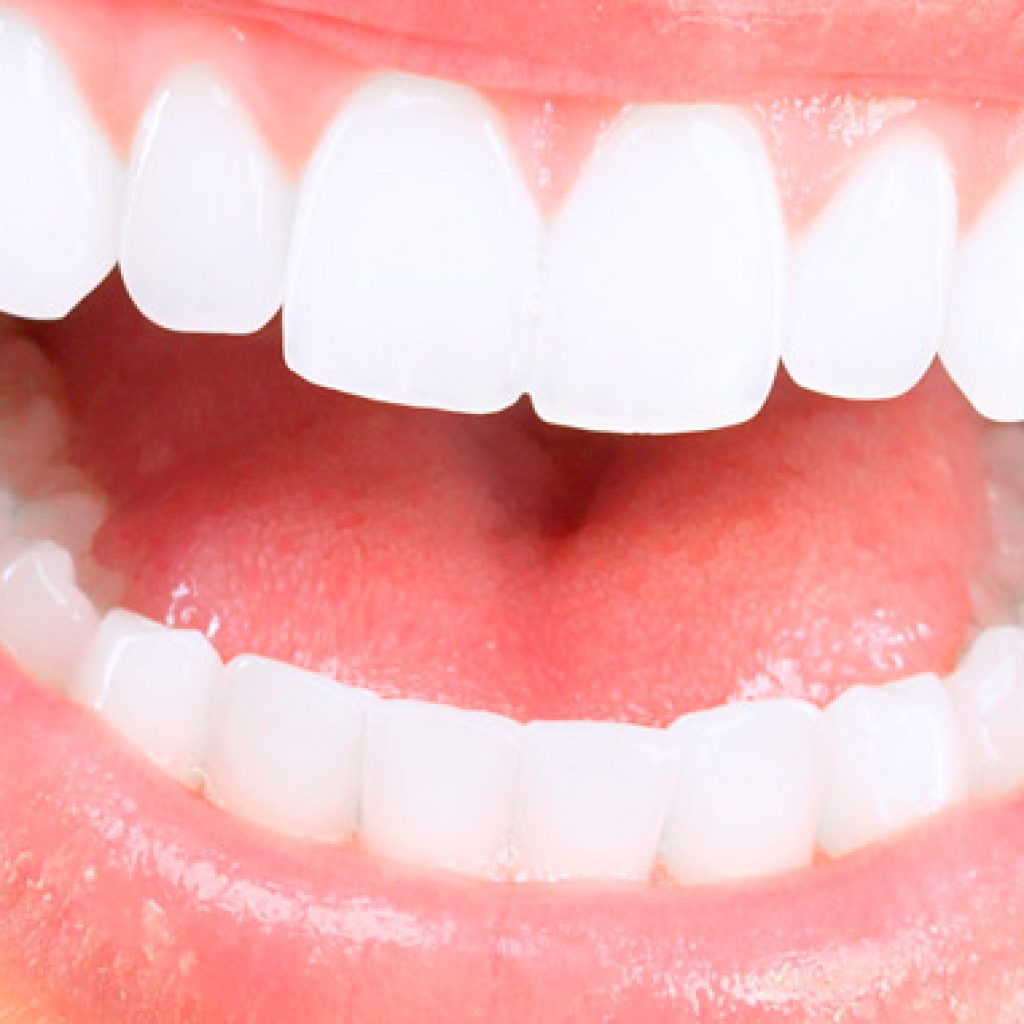 son comodos los implantes dentales