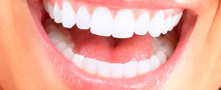 son comodos los implantes dentales