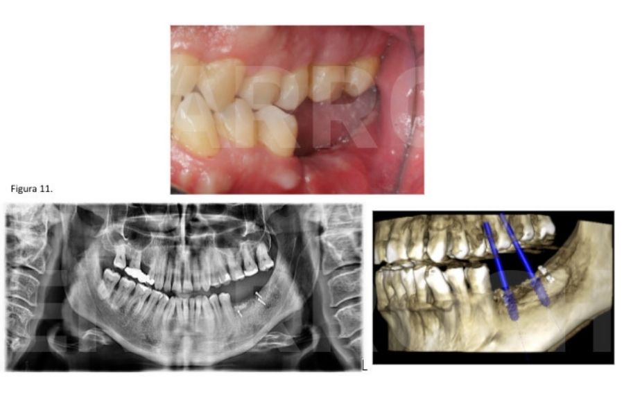 tecnicas de injerto oseo para implantes dentales