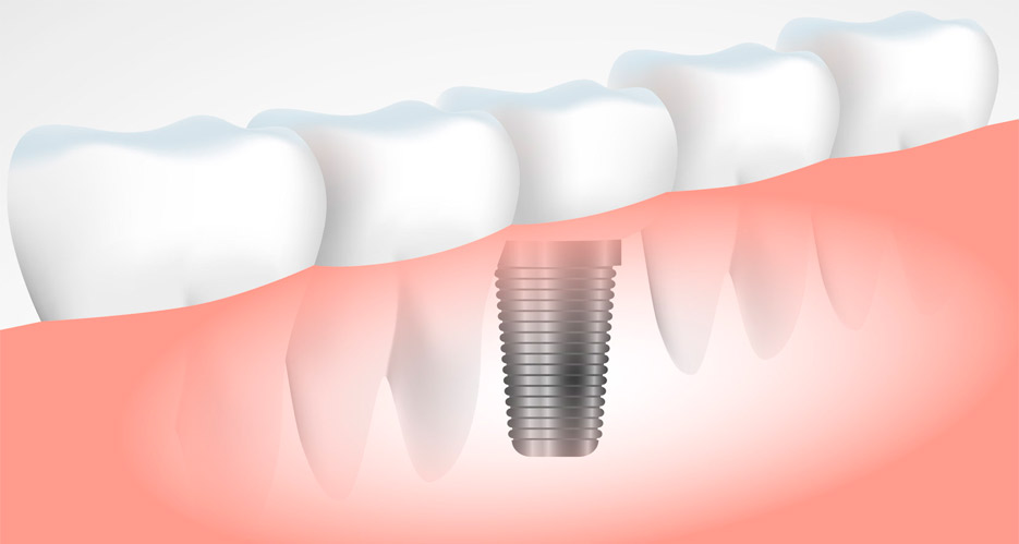 todo sobre la duracion del tratamiento de implantes dentales