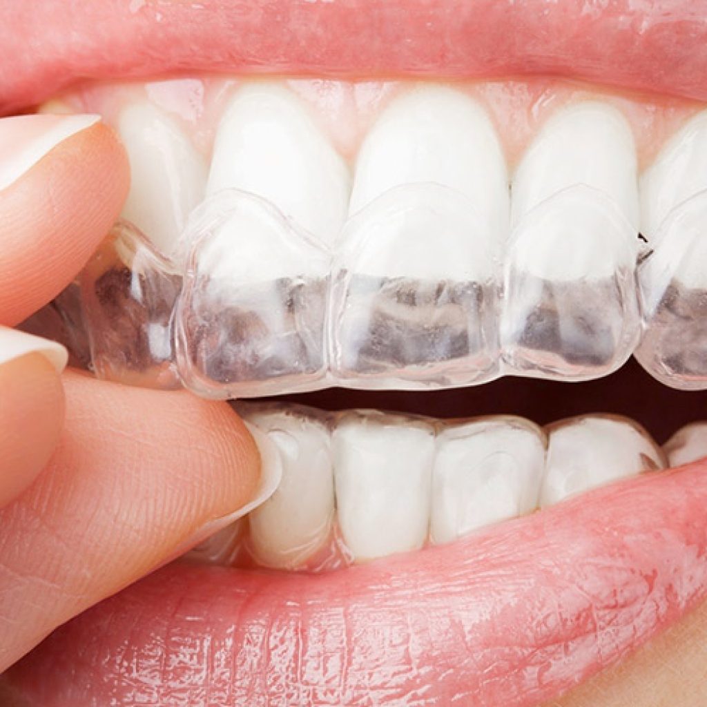 Tipos de retenedores dentales