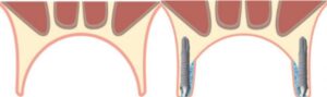 implantes palatinizados en maxilar atrofico idim clinica de implantes dentales en valencia