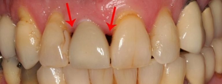 que son la troneras dentales